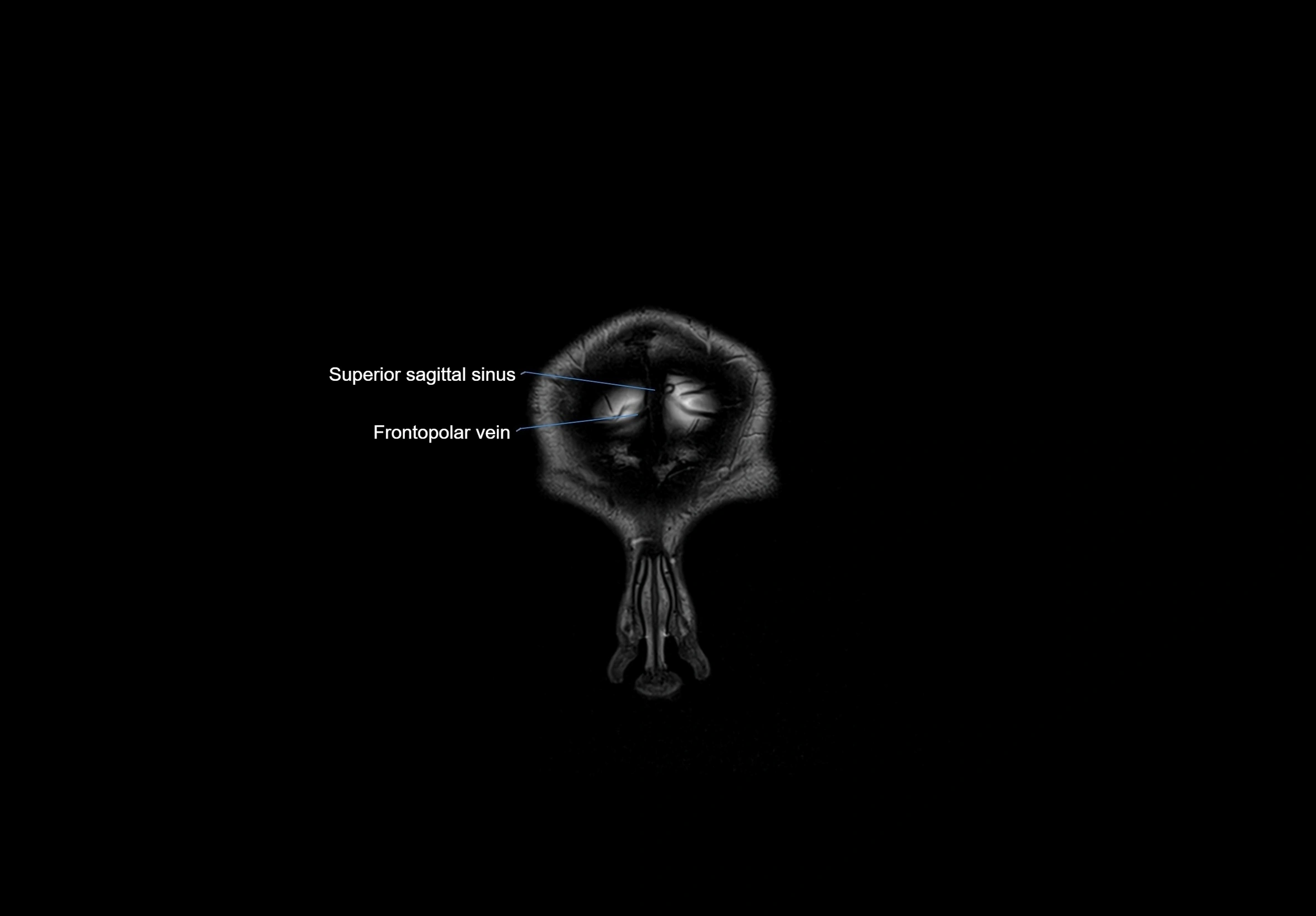 MRI Brain coronal cross sectional labelled anatomy 3T image  -img-00001-00004.webp
